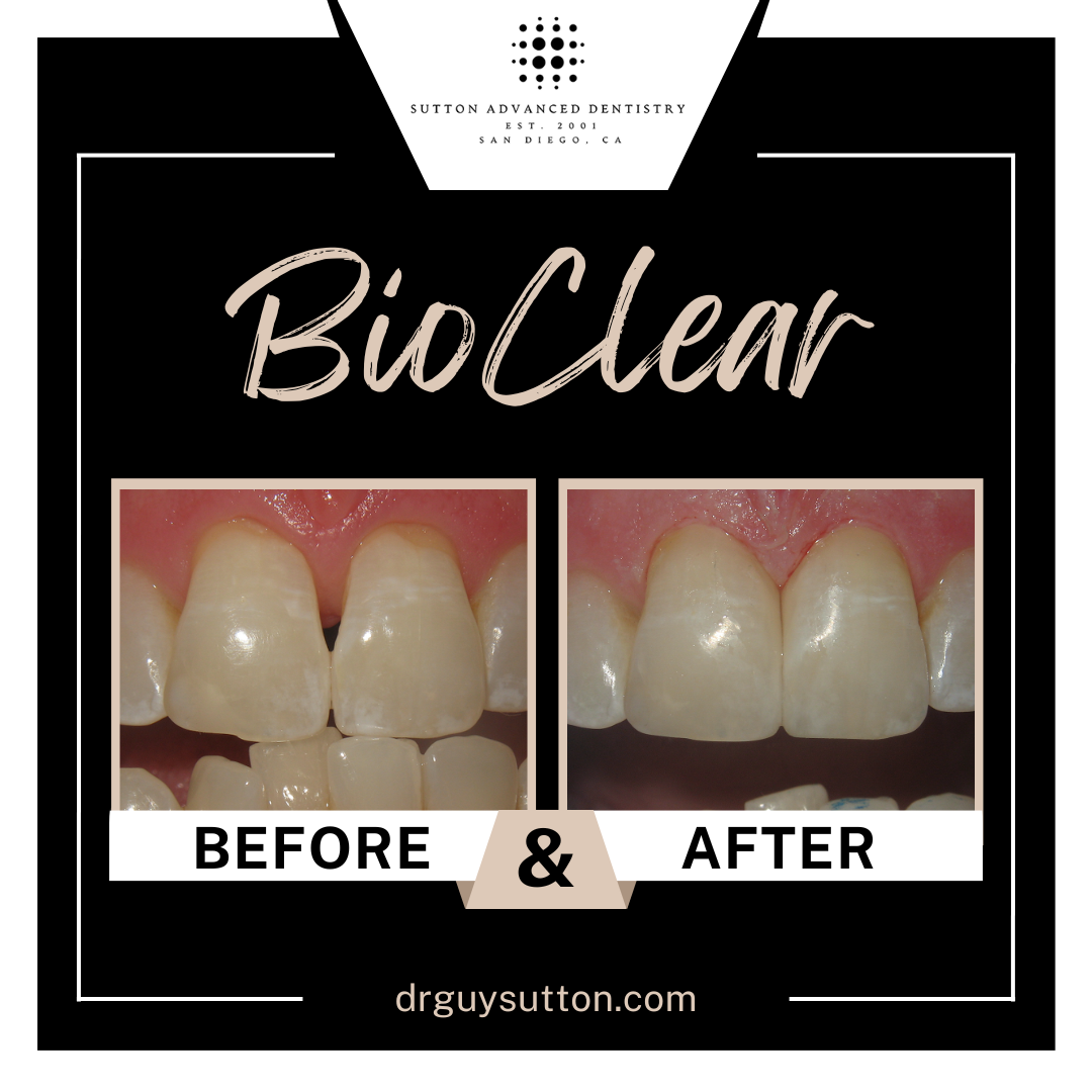 How is BioClear different from traditional dental veneers?