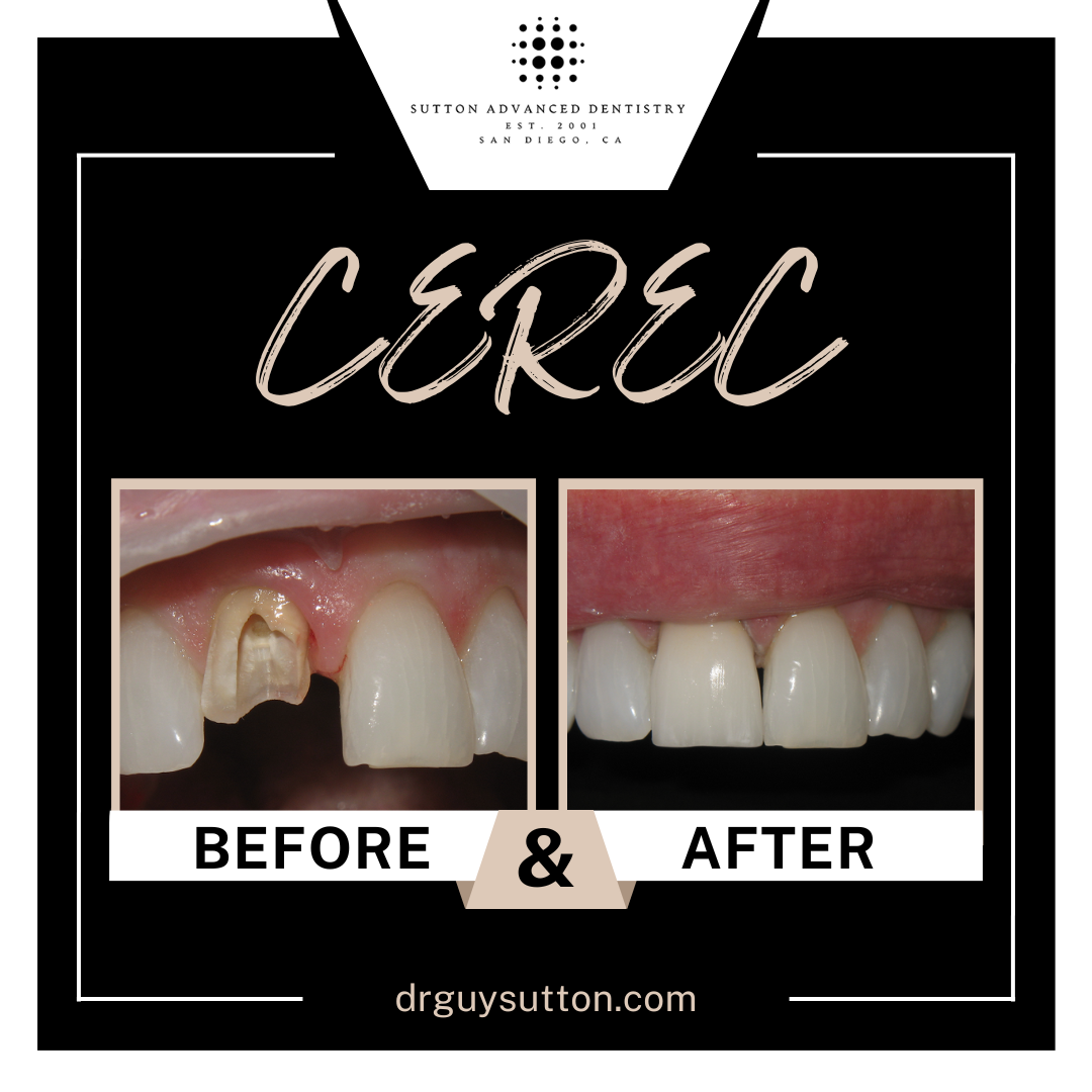 CEREC before and after